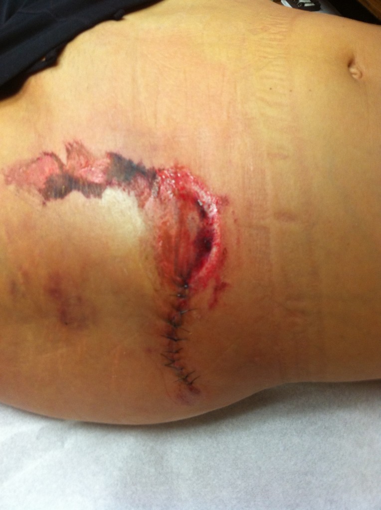 Yuck...but way better than the before pic